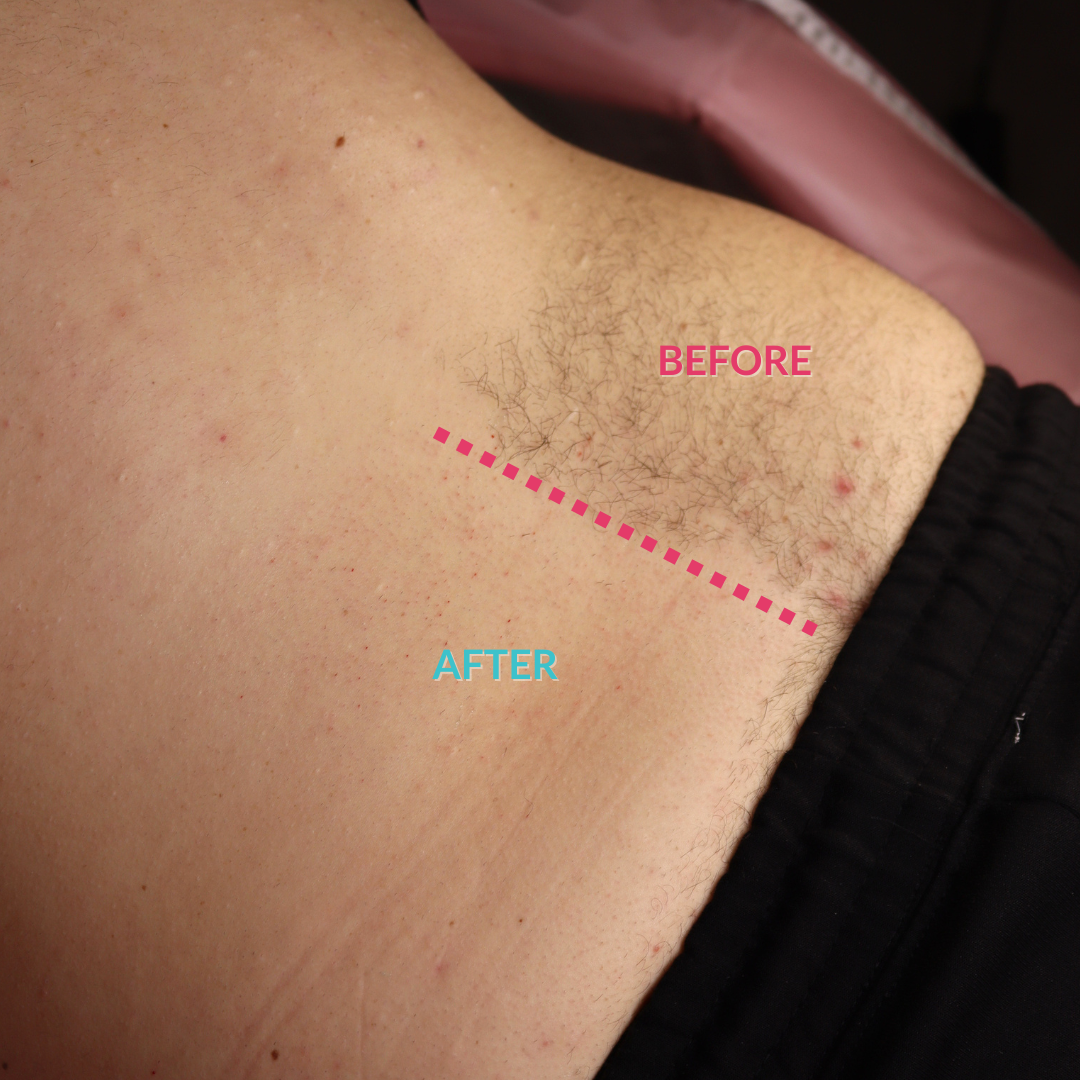 Close-up of a person's lower back area showing hair removal results, with pink 'BEFORE' and blue 'AFTER' text and a dashed line separating the two states.